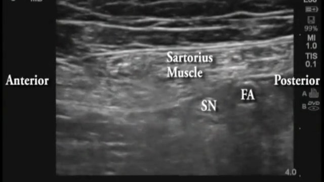 4: Ultrasound-Guided Mid-Thigh Saphenous Nerve Block
